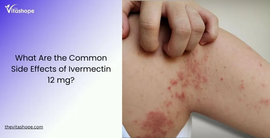 What Are the Common Side Effects of Ivermectin 12 mg?